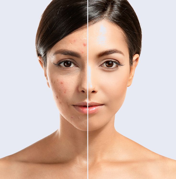 Tratamentos para Acne e Cicatrizes