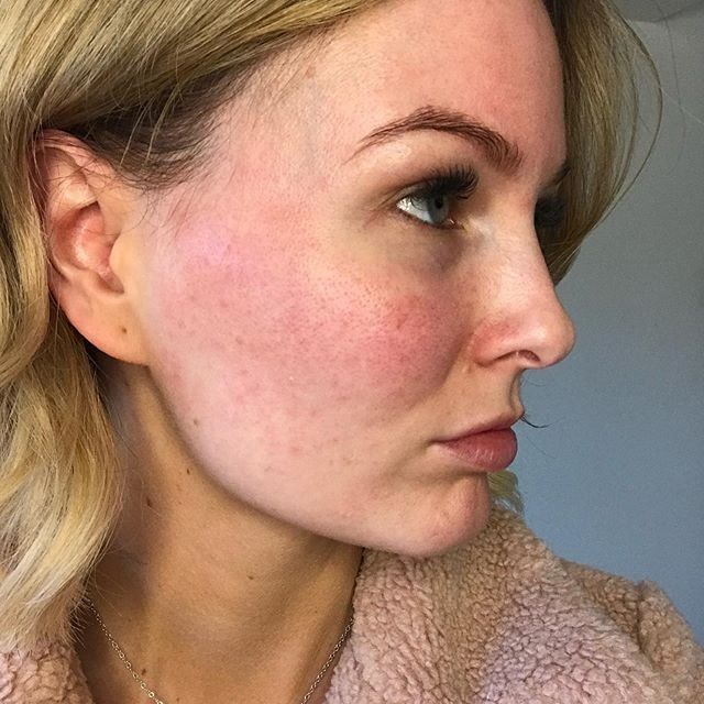 Cuidados com a Pele Sensível e com Rosácea